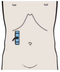 Probe position, Kidney, renal vein, colon