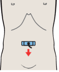 Probe position, Iliac arteries