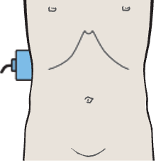 Probe position, Medullary pyramids