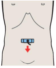 Probe position, Confluence of iliac veins