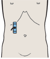 Probe position, Adrenal gland, vena cava, renal artery