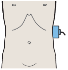 Probe position, Spleen, tail of pancreas