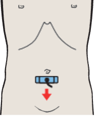 Probe position, Iliac vessels