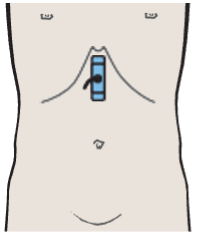 Probe position, Body of stomach, liver