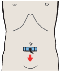 Probe position, Iliac vessels