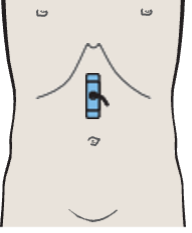 Probe position, Gastric folds
