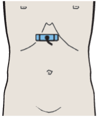 Probe position, Gastric folds