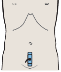 Probe position, Bladder, bowel