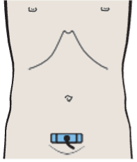 Probe position, Bladder, ureteral orifices