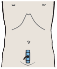 Probe position, Bladder, inflow of urine