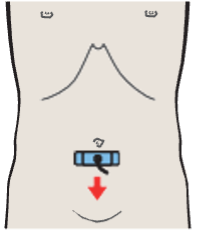 Probe position, Iliac vessels