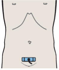 Probe position, Seminal vesicles, bladder