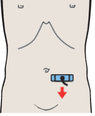 Probe position, Left iliac vessels