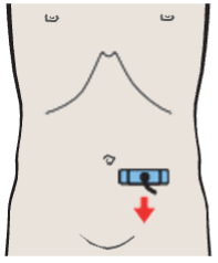 Probe position, Left iliac vessels