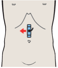 Probe position, Right renal artery and left renal vein