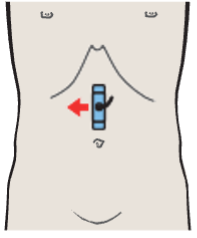 Probe position, Right renal artery and right renal vein