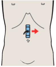Probe position, Right renal artery and left renal vein