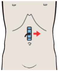 Probe position, Left renal vessels, splenic artery and vein