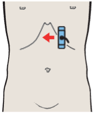 Probe position, Left lobe of liver, ligamentum teres, boundary between lateral and medial segments