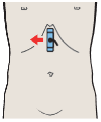 Probe position, Medial segment, subsegment IV, quadrate lobe