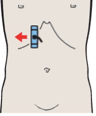 Probe position, Anterior segment, subsegments VIII and V