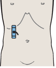 Probe position, Posterior segment, subsegments VII and VI
