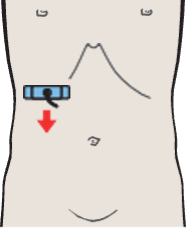 Probe position, Posterior segment, caudal subsegment, kidney