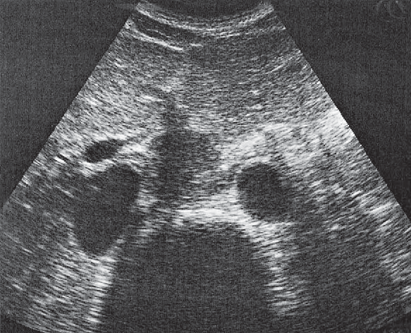 Right Lobe of Liver Ultrasound Anatomy