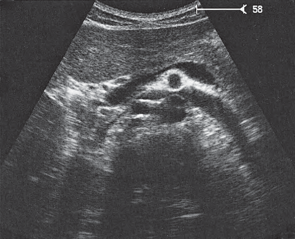 Left Renal Vein Ultrasound Anatomy