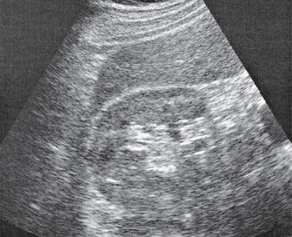 Posterior segment ultrasound image, Posterior segment, inferior border