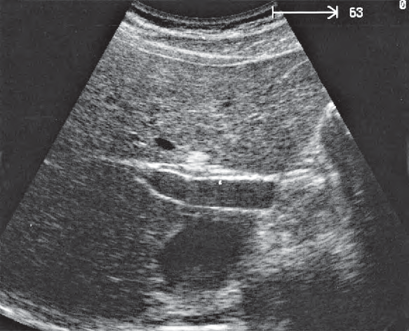 Duodenum ultrasound image, Right portal vein branch, ligamentum venosum