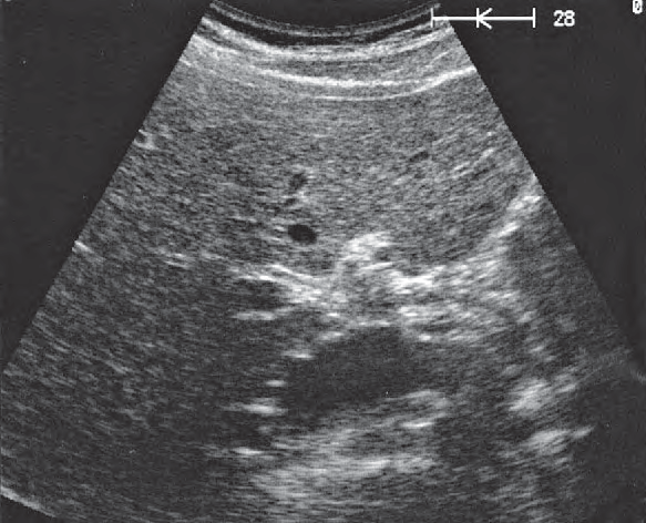 Cystic Duct Ultrasound Anatomy