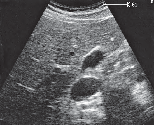 Neck of Gallbladder Ultrasound Anatomy