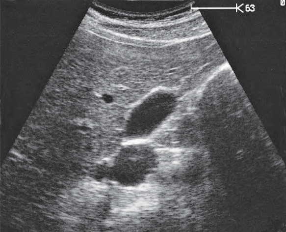 Body of Gallbladder Ultrasound Anatomy
