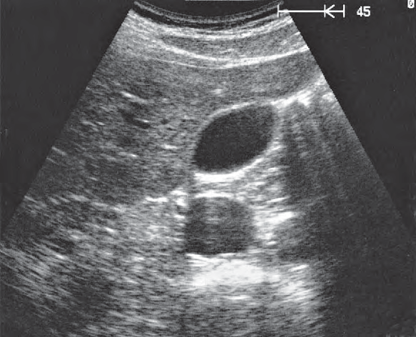 Fundus of Gallbladder Ultrasound Anatomy