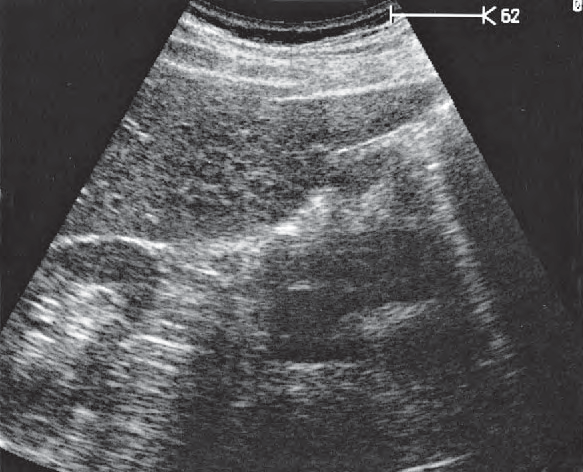 Right kidney ultrasound image, Gallbladder fundus, inferior border