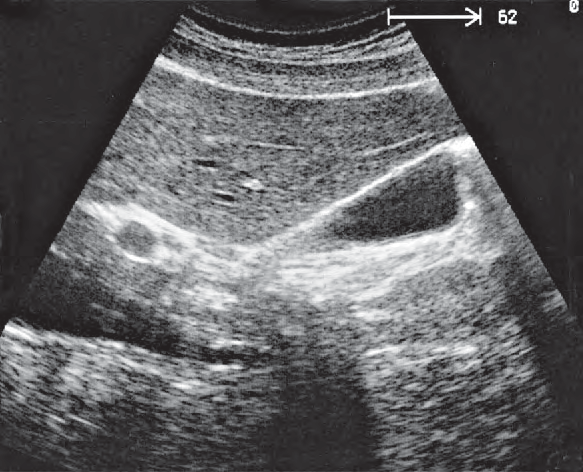 Duodenum ultrasound image, Right portal vein branch, duodenum, gallbladder body