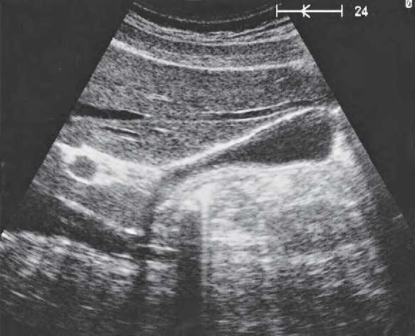 Duodenum ultrasound image, Right portal vein branch, body and neck of gallbladder