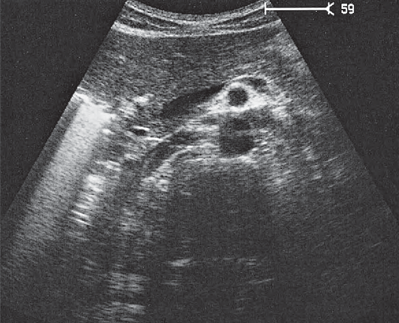 Artifact Ultrasound Anatomy