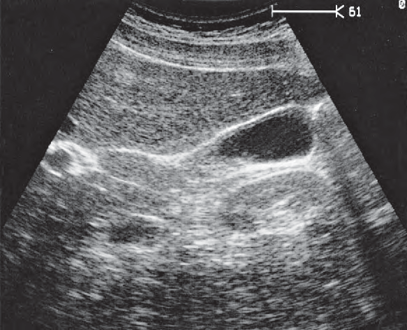 Gallbladder ultrasound image, Body and fundus of gallbladder, kidney