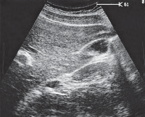 Gallbladder ultrasound image, Gallbladder fundus, kidney