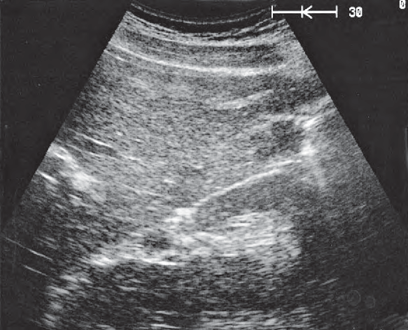 Gallbladder ultrasound image, Gallbladder fundus, kidney