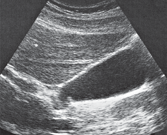 Spiral Folds Ultrasound Anatomy