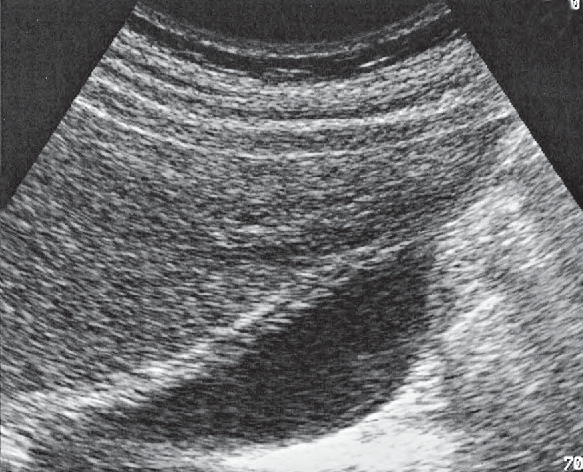Duodenum ultrasound image, Layers of the gallbladder wall