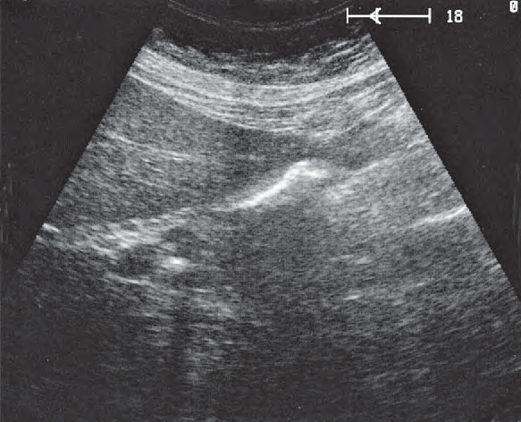 Duodenum ultrasound image, Duodenum lateral to head of pancreas