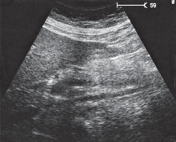 Head of Pancreas Ultrasound Anatomy