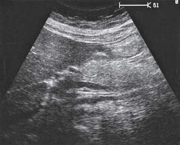 Caudate lobe ultrasound image, Head of pancreas, bile duct