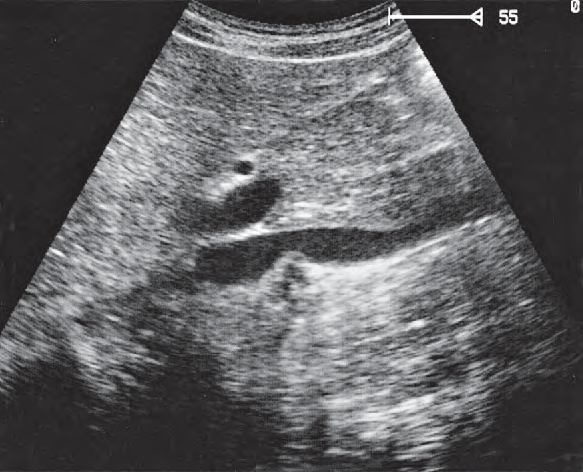 Acoustic shadow ultrasound image, Head of pancreas, hilar vessels, vena cava