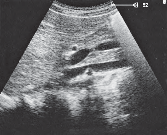 Uncinate Process Ultrasound Anatomy