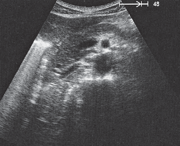 Stomach ultrasound image, Infrarenal aorta and vena cava